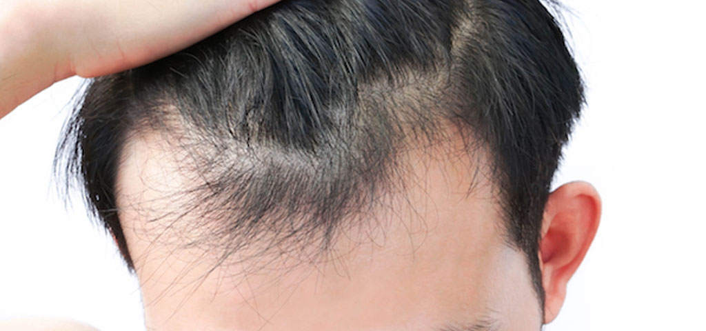 Chicago Hair Transplant Blog – 2
